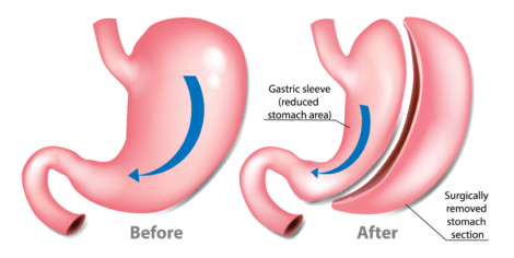 Gastric Sleeve Surgery In Tijuana - Tijuana Bariatric Solutions